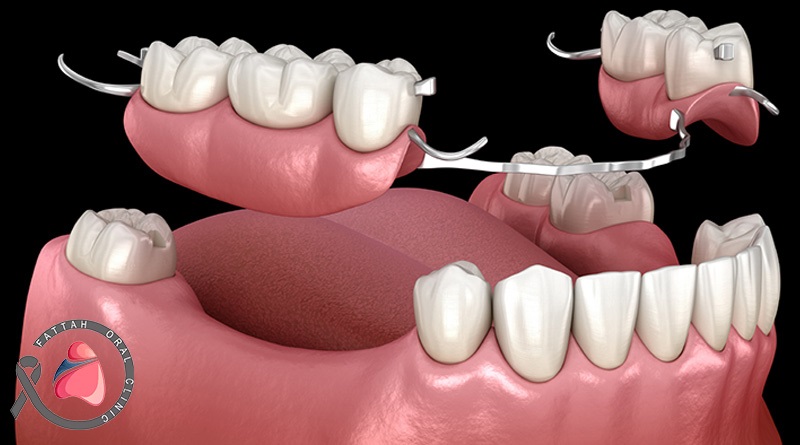 ساخت پروتز دندان در کلینیک دهان و دندان فتاح