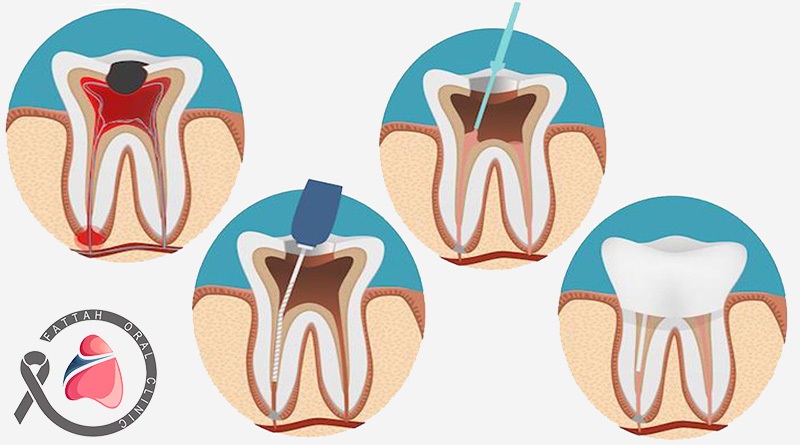 عصب کشی در کلینیک دهان و دندان فتاح
