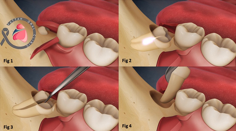 جراحی دندان عقل در کلینیک دهان و دندان فتاح